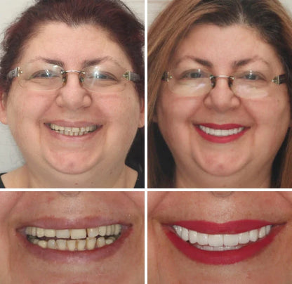 Full Denture Set Moldable Custom Fit Natural-Looking Teeth