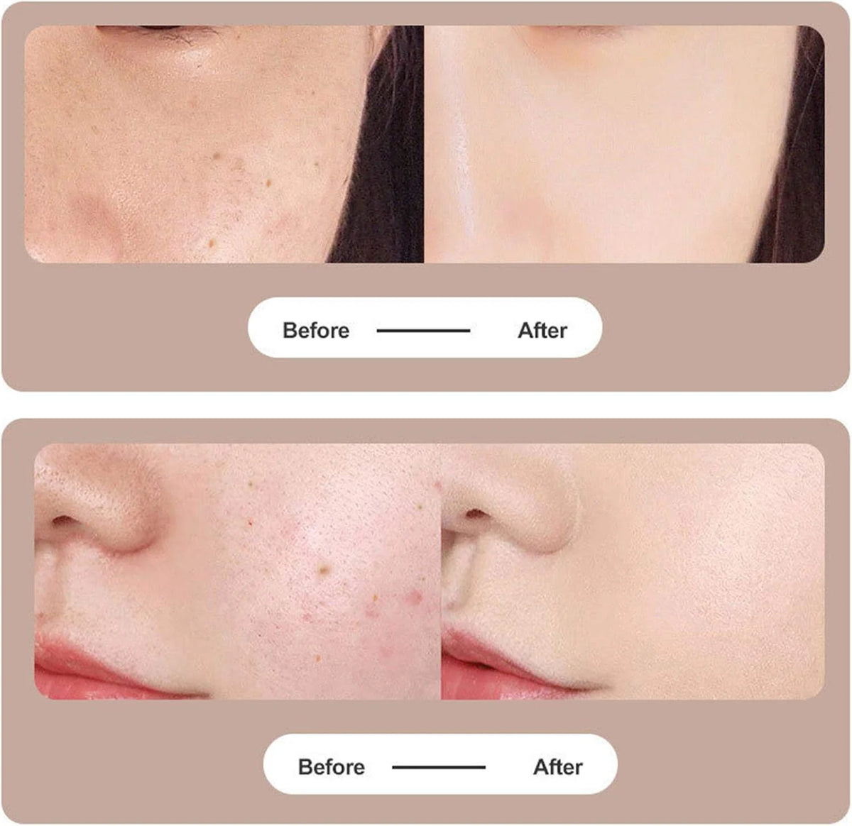Skin Blemish Removal Pen Plasma Therapy & USB Rechargeable