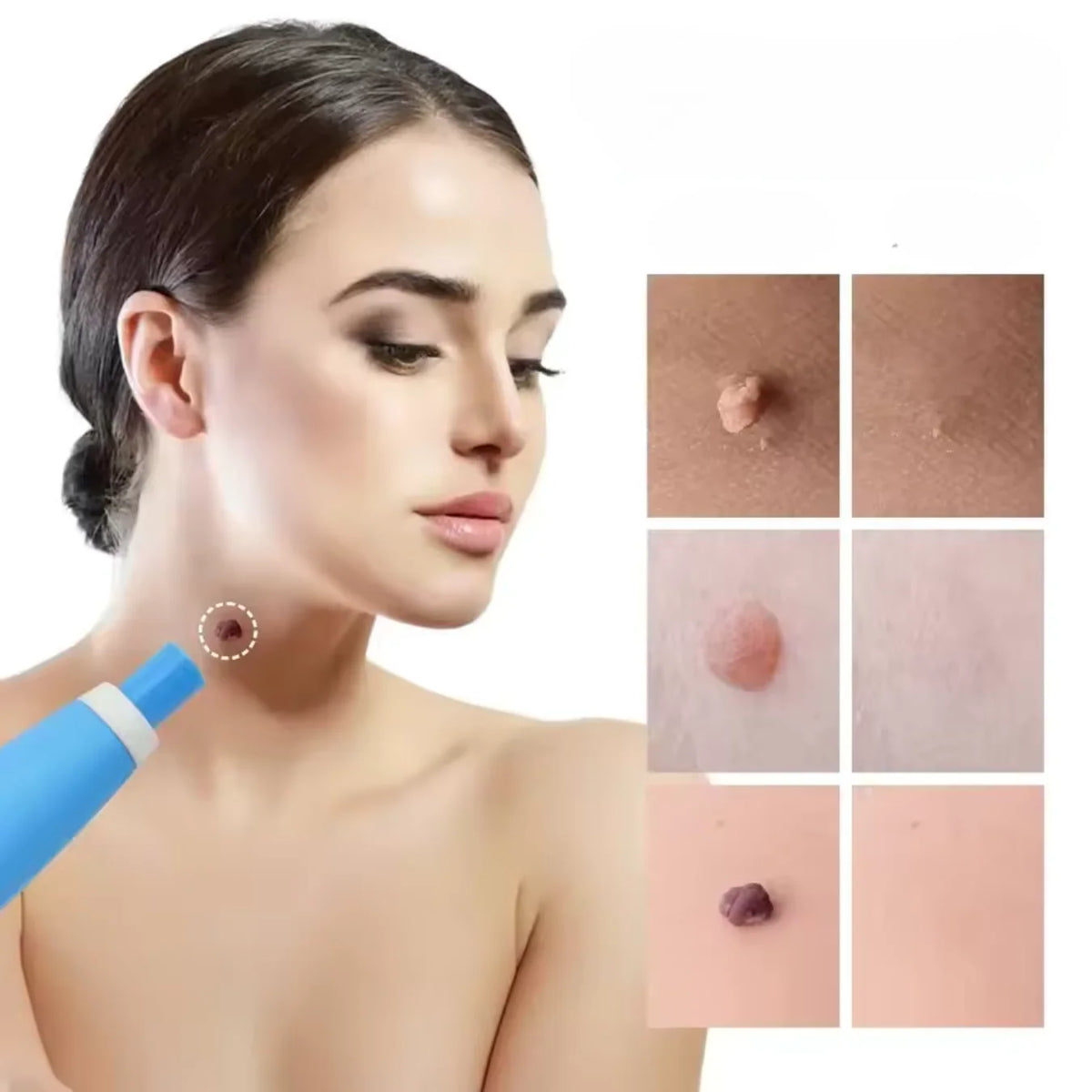 Skin Tag Removal Bands Silicone Chemical Free 40 Pack