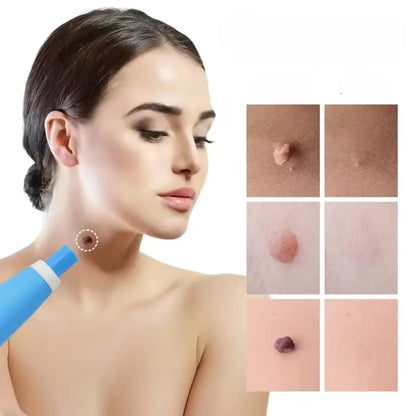 Skin Tag Removal Bands Silicone Chemical Free 40 Pack