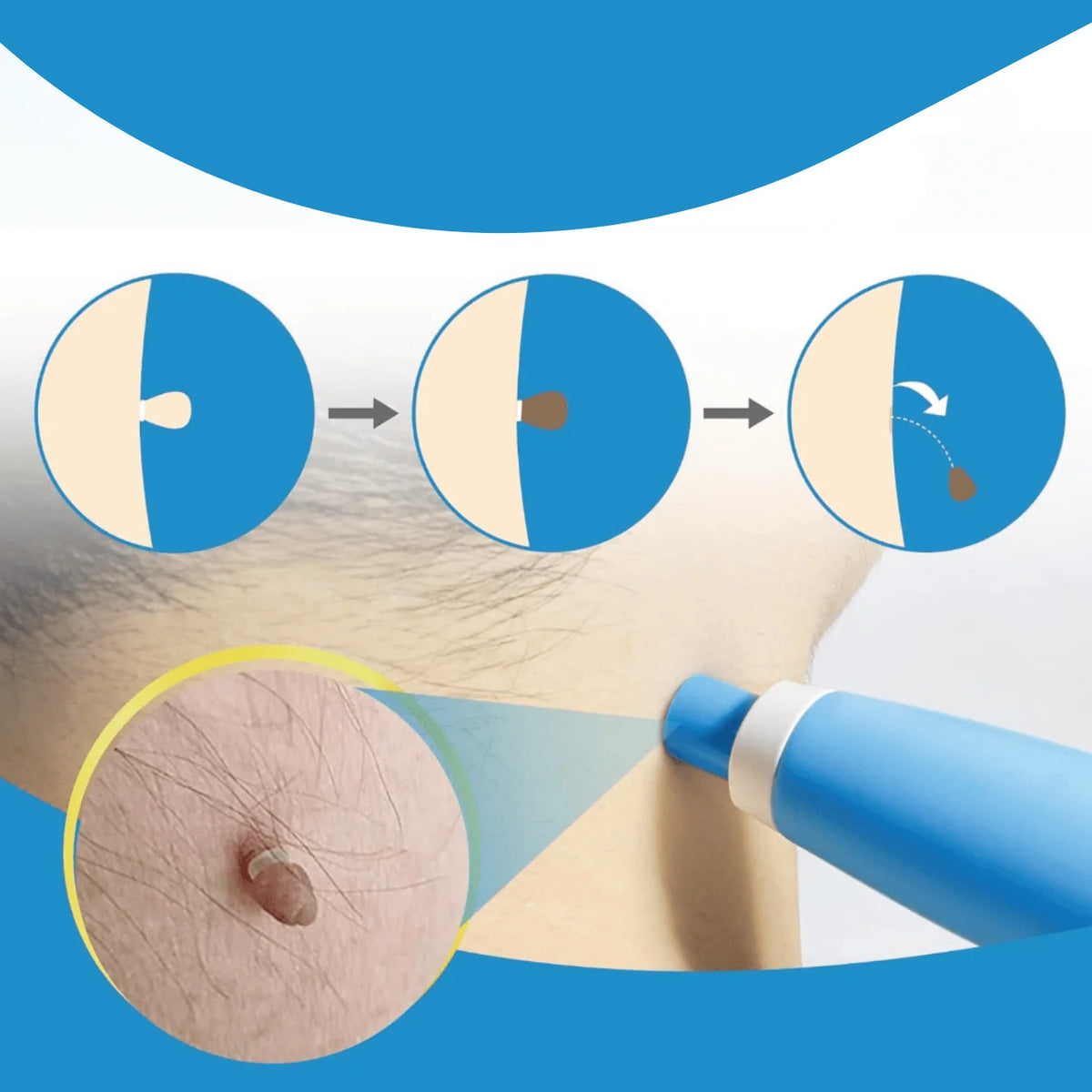 Skin Tag Removal Bands Silicone Chemical Free 40 Pack