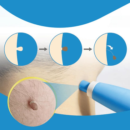 Skin Tag Removal Bands Silicone Chemical Free 40 Pack